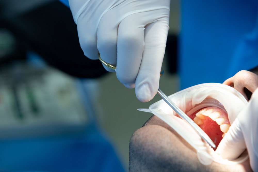 Debunking the Fear: What Really Happens During a Root Canal?